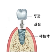 种植体的结构